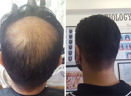 mens hair loss