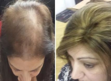 Womens Hair Loss - Female Hair Replacement Systems